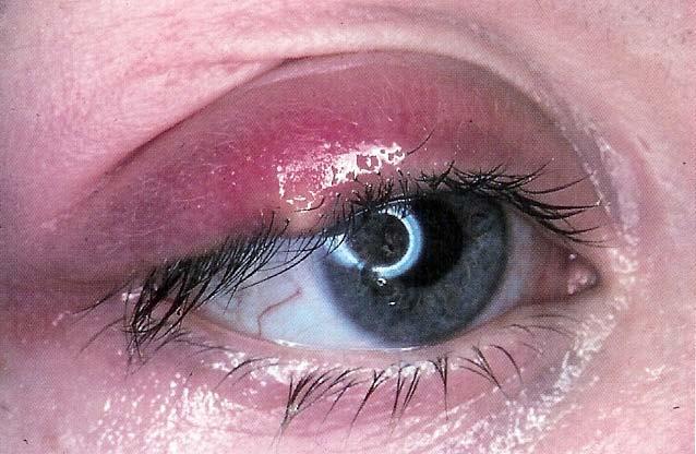 Hordeolum (stye) Acute staphylococcal infection of a gland of Moll or Zeiss (external