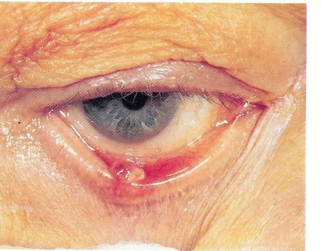 Sebaceous Carcinoma Adenocarcinoma of Meibomian or Zeis glands Can mimic chronic chalazion