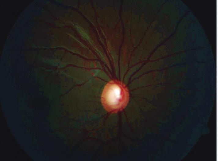 Introduction and aims of the study activity, can at the same time paradoxically contribute to visual impairment; Corticosteroids can induce various eye-related problems such as cataract formation or