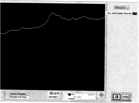 Initial Scan Of Client Before Sessions Final Scan After 40 Sessions Divergence Numbers = Right & Left Brain Hemisphere