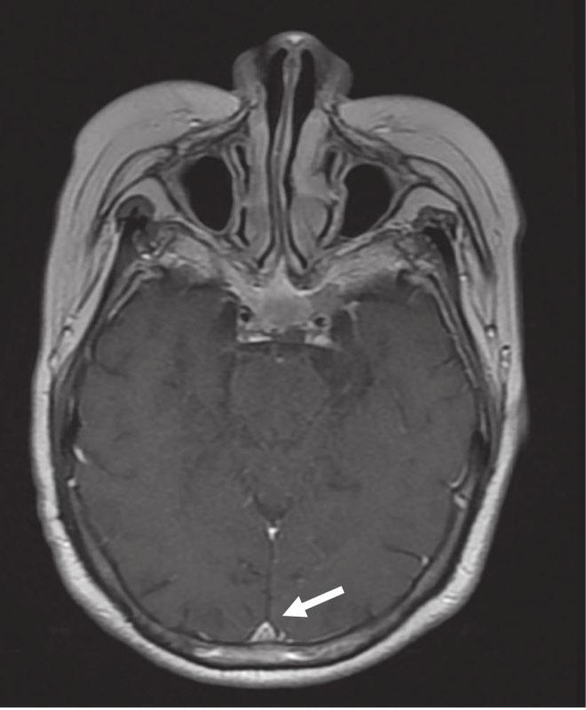 MRI T2 flair image before treatment; (c) Brain