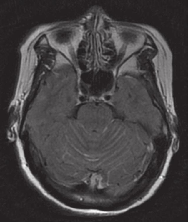 T1+C before treatment; (b) Brain MRI T2 flair image before treatment; (c) Brain MRI T1+C image after