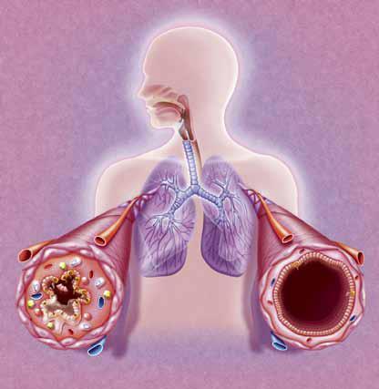 Pharmacology of drugs used in bronchial asthma & COPD By