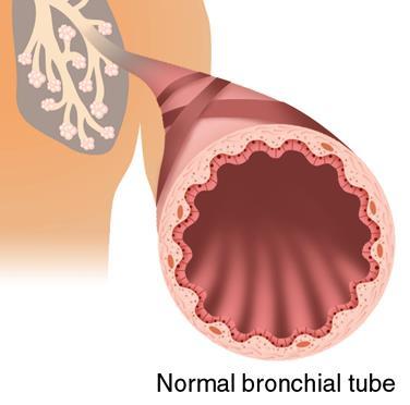 smooth muscle (bronchoconstriction) inflammation of the airway wall (swelling in