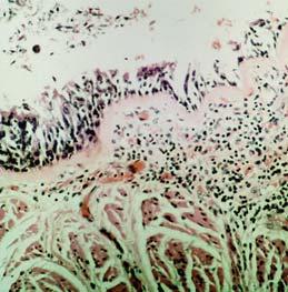 145:922, 1992 Defining Asthma: Pathological Features Epithelial sloughing Goblet cell