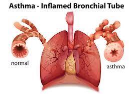 BIOLOGICS IN ASTHMA MANAGEMENT Indications Mechanism of