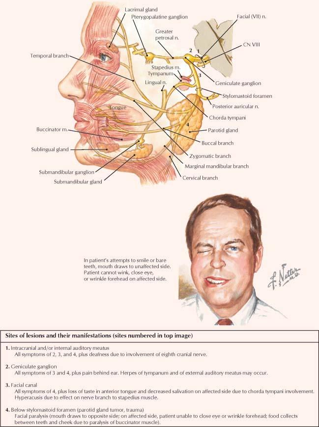 Facial Nerve (VII): Lesion Bell s palsy: paralysis of facial expression mm.