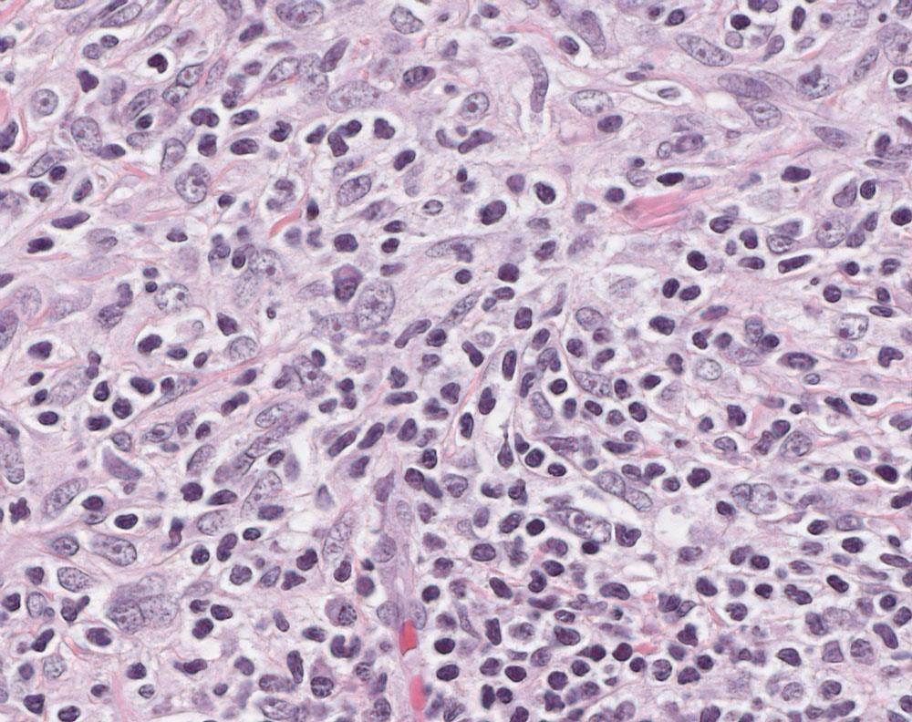 Histology Fibroblasticmyofibroblastic cells Inflammatory cells Collagen