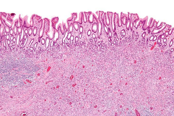 Differential diagnosis Inflammatory fibroid polyp Submucosa of Gastric antrum
