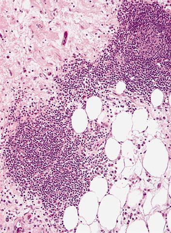Differential diagnosis Inflammatory liposarcoma Retroperitoneum of older adults Prominent