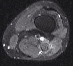 IPT of sciatic nerve 61 year old women Irregular, mass lesion that
