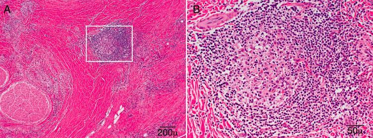 Histology Rare non-caseating granulomas and