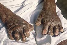 Differential diagnosis Leprosy M. leprae and M.