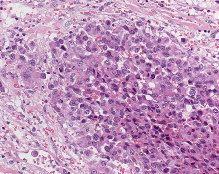 Differential diagnosis Epithelioid sarcoma Multinodular Epitheloid cells, spindled at