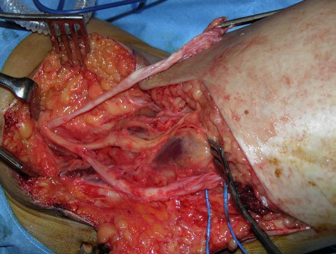 Therapy Nerve sparing resection Improvement in pain,
