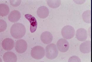 Figure.5 Leishman stained smear showing gametocyte forms of P.