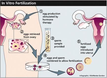 IVF Step 4 Step 4: culture and transfer Fertilized oocytes put on growth medium Embryos graded (#