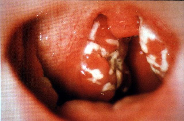 Acute Pharyngitis By far the most common infection of the upper respiratory tract Viral infection is by far the most common cause of