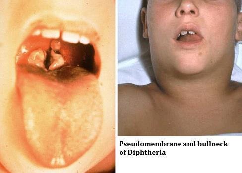 C. diphtheriae Respiratory diphtheria occurs as membranous nasopharyngitis and obstructive