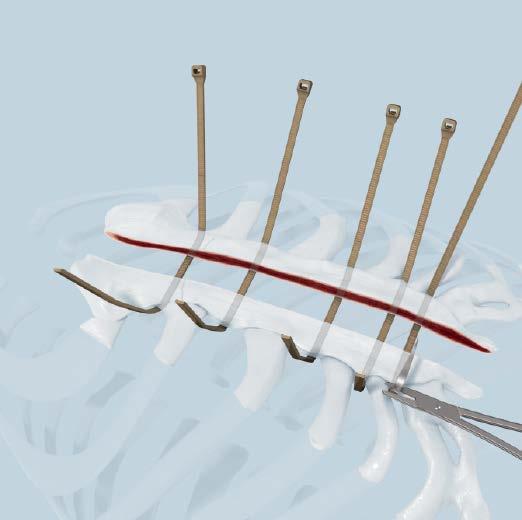 The ZIPFIX Sternal System can be used with plates and/or wires or where ZIPFIX Implant insertion is inhibited by patient anatomy.