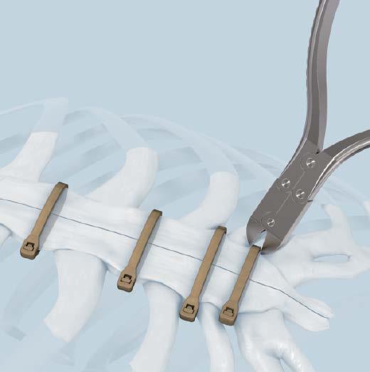IMPLANT REMOVAL 1 Cut Sternal ZIPFIX Implants Instrument 391.905 Cable Cutter, standard Cut all ZIPFIX Implants with the cable cutter.