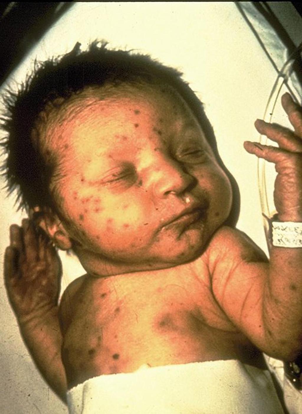 Rubella Virus Rash and fever Birth defects if women infected while pregnant Deafness,