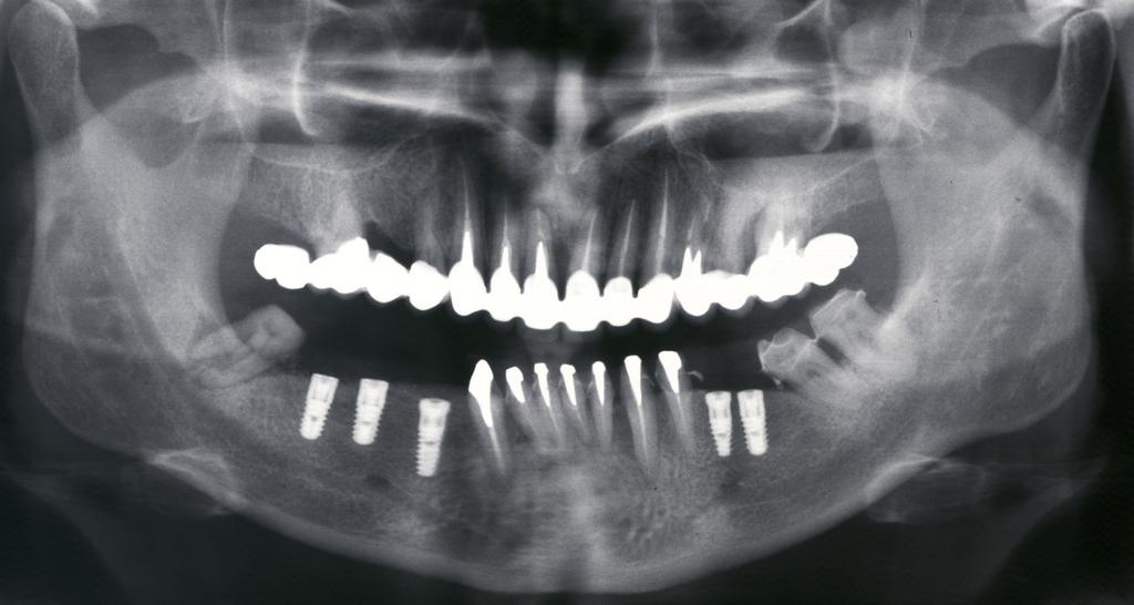 Fig. 1: Postoperative radiograph after placement of 5 Bredent dental implants in the