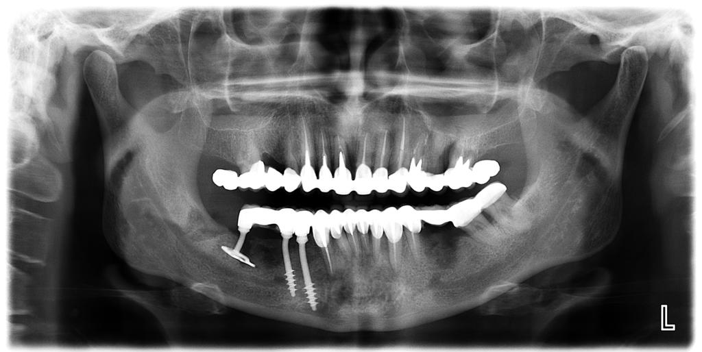 Fig. 3: Circular bridge on teeth and 3 basal implants with adjusted chewing