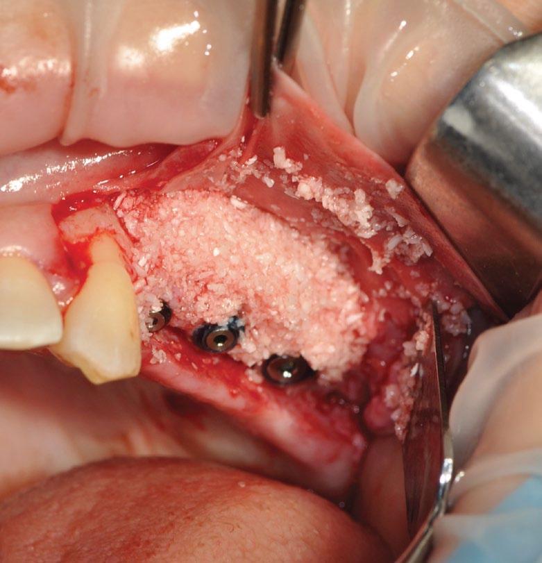 2 Flap opening, a substantial vestibular bone