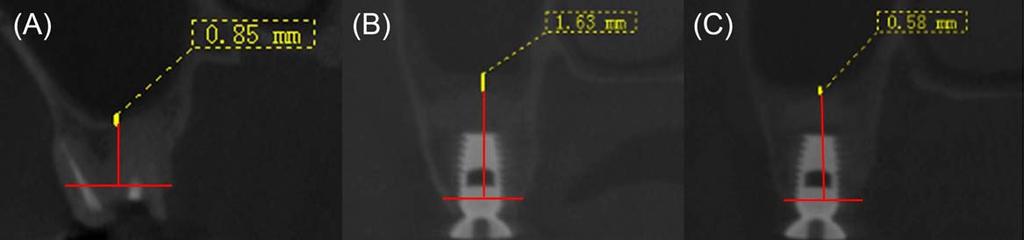 CHEN ET AL. 7 FIGURE 4 CBCT illustrated maxillary mucosa thickness change in T1, T2, and T3 in group 2.