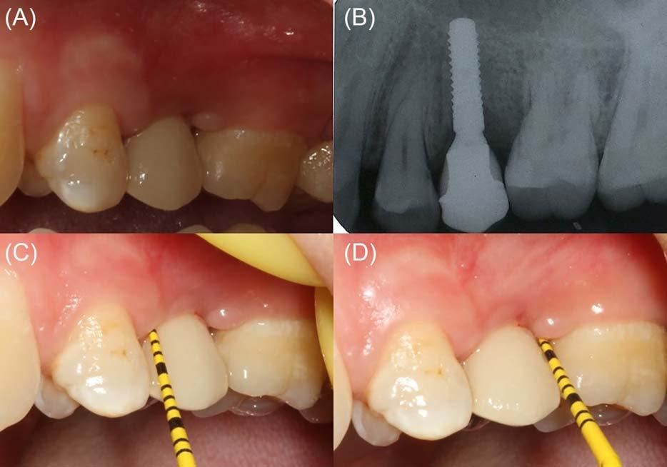 8 CHEN ET AL. FIGURE 6 Oral and radiographic examination was evaluated at 1-year follow-up. A, Lateral oral view of the implant site.