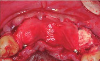 Perforation of vestibular