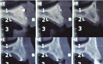 Placing of Apatos bone with