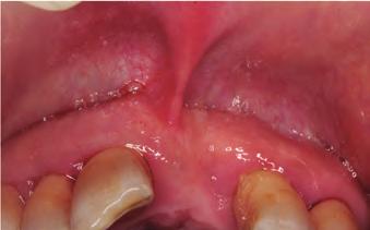tooth mobility issues, three