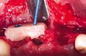 maxgraft block covered with cerabone and