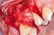 Sinus lift: maxresorb ; Jason membrane case
