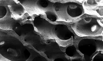 SEM: cerabone (macro- and micropores resembling human bone). cerabone excellent biofunctionality; superior hydrophilicity and blood uptake. Histology of cerabone 6 months after Sinus lift.