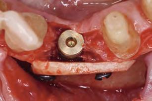 osseointegration, thus reducing the fracture risk during screw