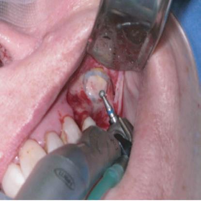 Procedure Horizontal Augmentation with Autogenous and