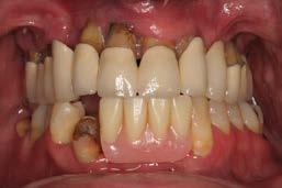 lingual concavities Cover with barrier or Alloderm if mucosal