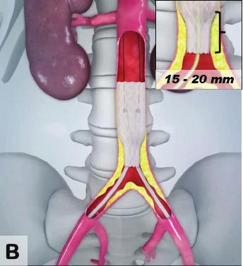 procedure the proximal part of the aortic covered stent is overdilated to adapt to the aortic wall Figure 1C The CERAB configuration is completed by simultaneous inflation of two iliac covered stents