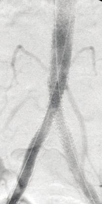 The CERAB configuration was then constructed using an Advanta V12 LD 12 x 61mm covered stent (Atrium Medical) that was proximally dilated to 16mm, using a 16 x 40mm semicompliant Cristal balloon