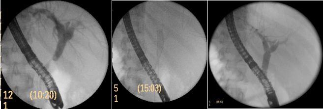 ERCP following the extraction of the stent. Fig. 3.