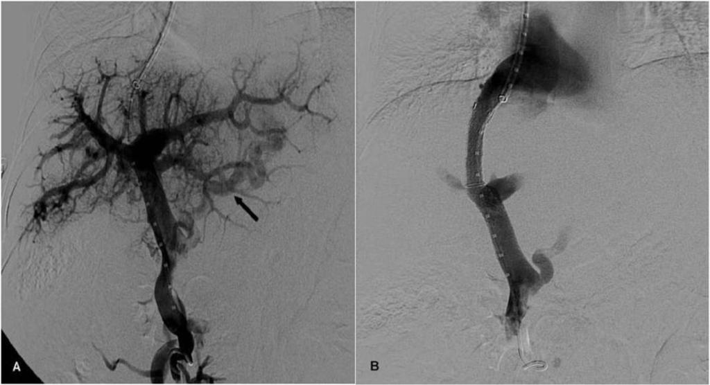 Fig. 3: Eleven-year-old boy with extrahepatic biliary atresia and secundary signs of portal hypertension (esophageal varices, splenomegaly and thrombocytopenia) admitted to our hospital for acute