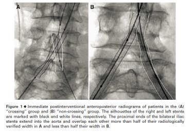 .. ISSUES AROUND RAISING THE AORTIC BIFURCATION Greiner and colleagues showed that if the proximal end of the kissing stents overlapped by more than half of the angiographic width within the aorta