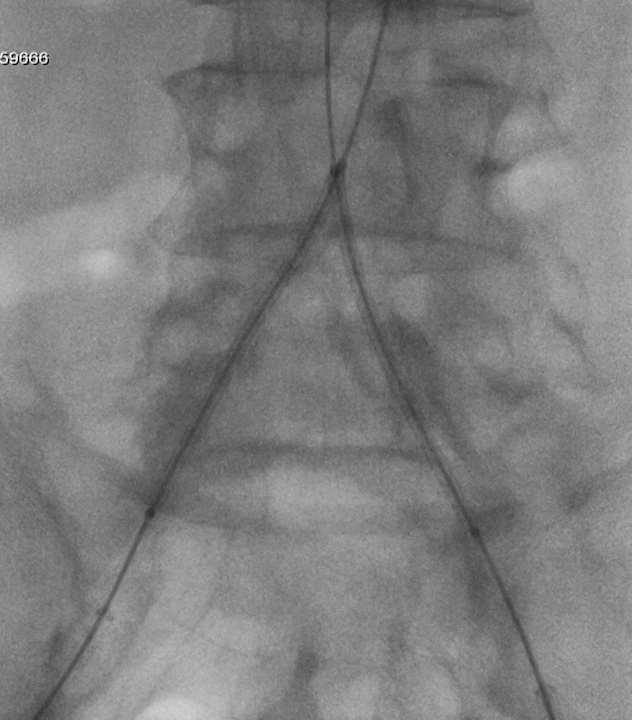 Stent Deployment (Ends to