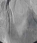 v occl. Sharp needle from superior approach.