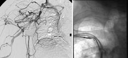 AJR (2010) 5:1352-6 Complications Hematoma Hemothorax Pnuemothorax Dissection Extravasation Arterial Injury Nerve Injury Death Dissection with