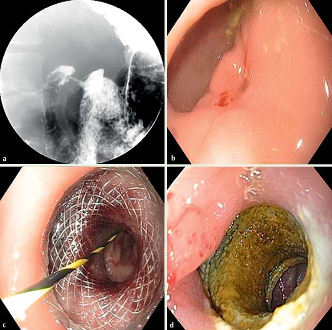 b Endoscopic view of the stricture. c The distal flange of the stent was partially opened inside the Roux limb stricture.
