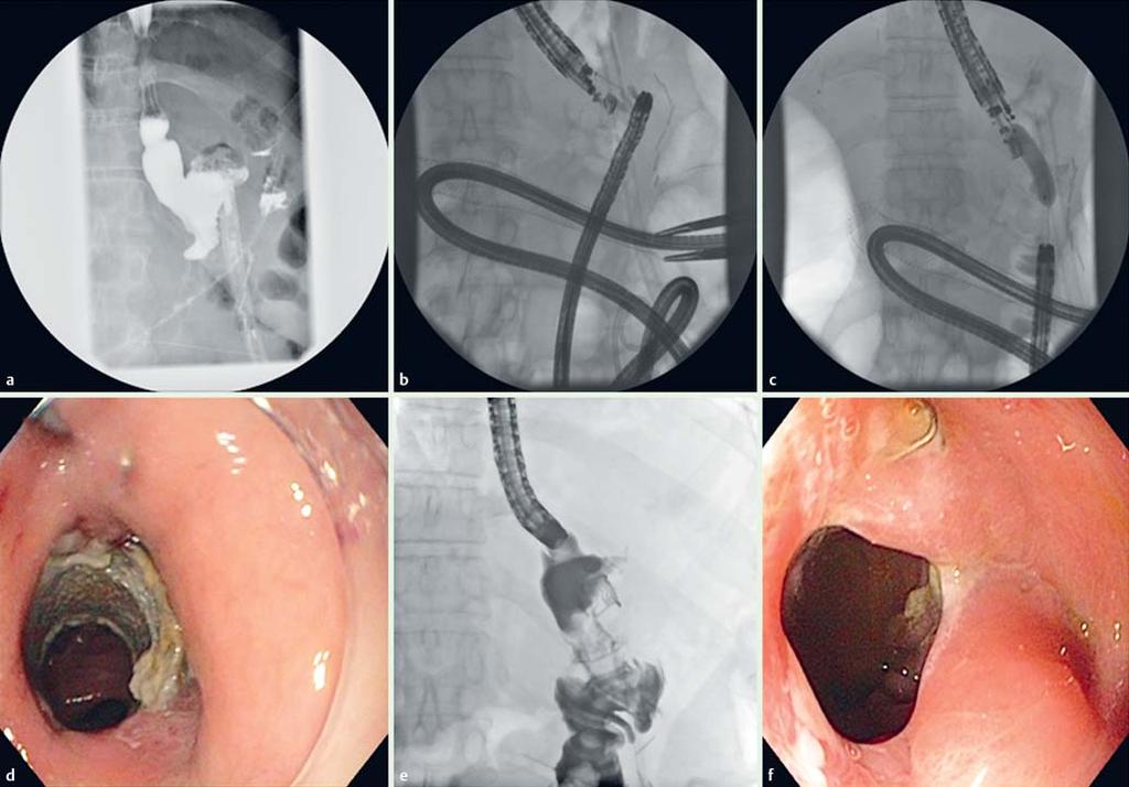 THIEME E99 Fig. 4 a Contrast study demonstrating anastomotic leak at the gastric vertical staple line and complete gastrojejunostomy stricture.